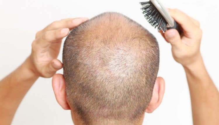 İstanbul saç ekimi yapan yerler