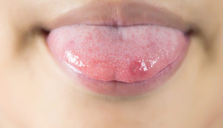 Ağızda Aft Yarası Neden Çıkar? Tedavisi Nedir? Nasıl Geçer?